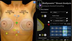 BioDynamic Software zur Implantatswahl