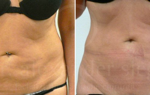 Bauchdeckenstraffung Abdominoplastik In Wien Und Linz Dr Siegl