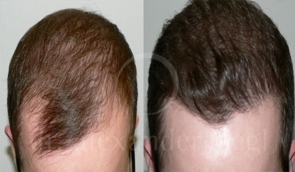 Haartransplantation Fue In Wien Linz Dr Alexander Siegl